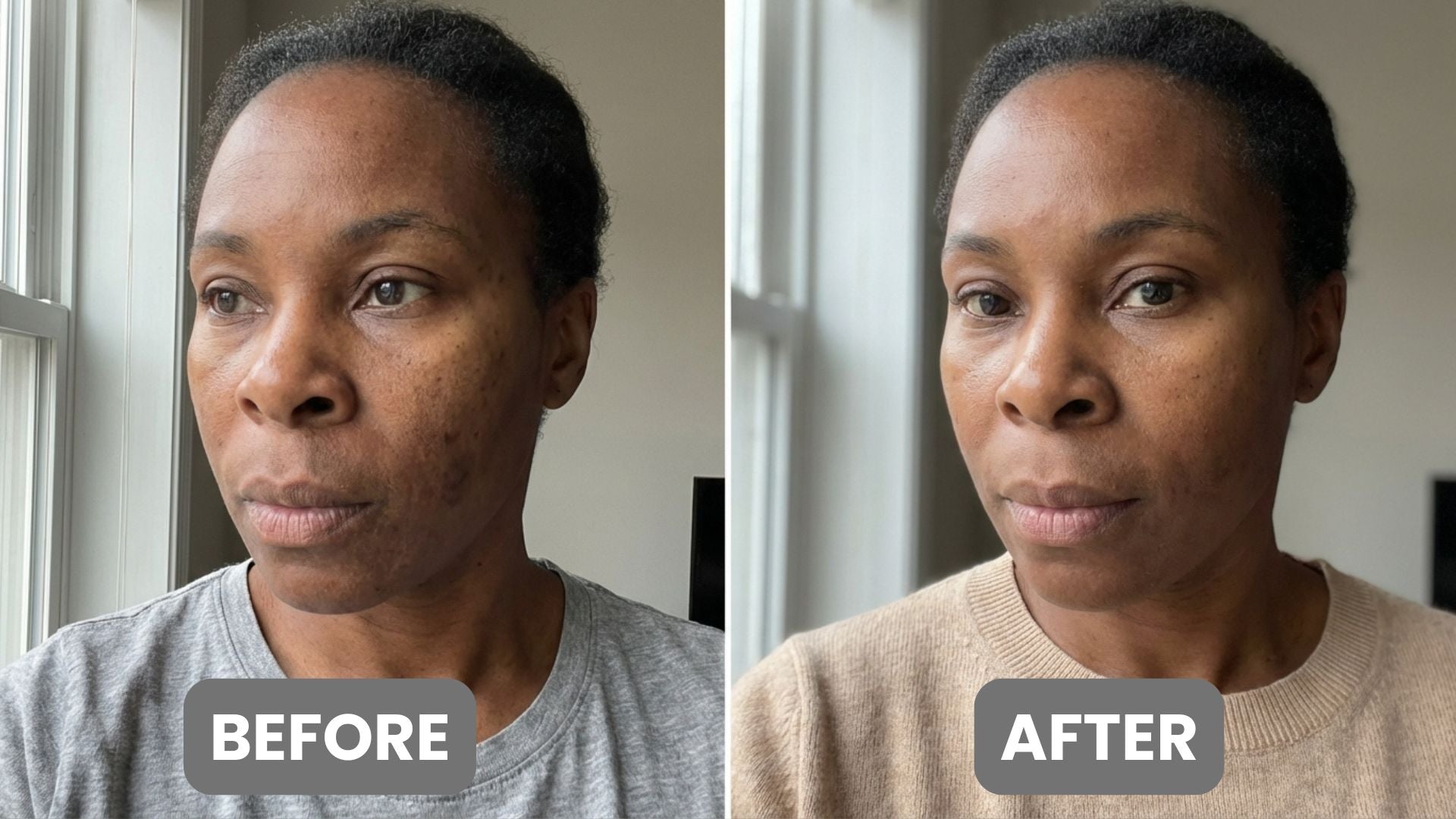 Hyperpigmentation
